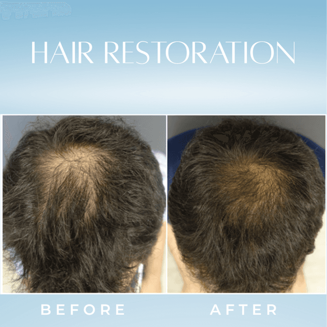 Hair restoration at White Lotus Medical Spa in Scottsdale, AZ