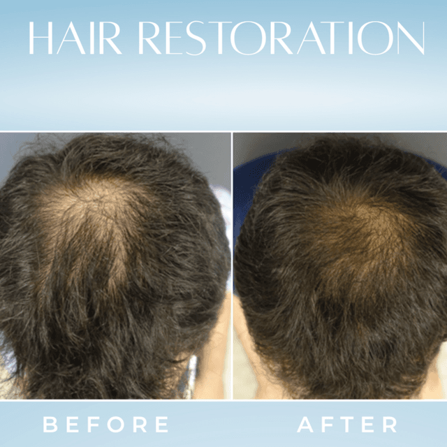 Hair restoration at White Lotus Medical Spa in Scottsdale, AZ